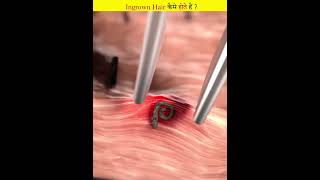 How do ingrown hairs grow [upl. by Fayth313]