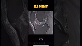 Fig 1A11 Meniscofemoral ligaments Humphrey ligament [upl. by Hadihahs]