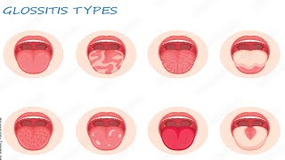 Glossitis benign migratory glossitis geographic tongue [upl. by Ayikaz]