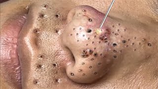 Blackhead Removal With Sac Dep Spa 1000277 [upl. by Janerich]