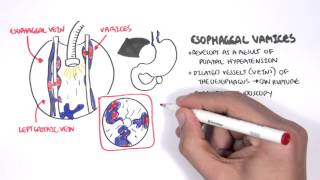 Upper GI Bleed Causes Overview [upl. by Ahtnahc892]