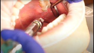 Inferior Alveolar Nerve Block Demonstration and Overview 4K [upl. by Ylenaj543]