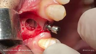 IMPLANTOLOGY  REX CASE REPORT Implant in thin crest  Dr Alberto Rebaudi [upl. by Drus408]