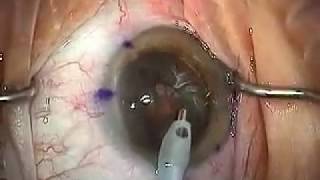 Modern Cataract Surgery Alcon ReSTOR IOL with LRI [upl. by Etram202]