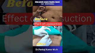 Result of laser liposuction to Remove body fat laser liposuction shorts liposuction [upl. by Navis]