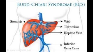 Budd chiari Syndrome  Definition causes Types Symptoms Diagnosis Treatment [upl. by Euqnimod]