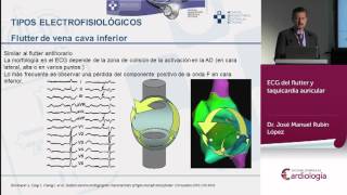 ECG del flutter y taquicardia auricular [upl. by Flan]