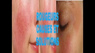 ROUGEURS SUR LE VISAGE COMMENT Y REMÉDIER [upl. by Repsihw]