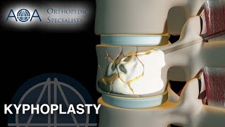 AOA Orthopedic Specialists  Kyphoplasty [upl. by Hahsia971]