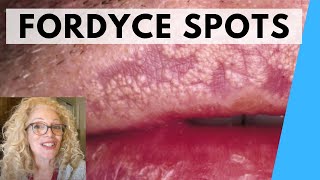 SYRINGOMA VS FORDYCE SPOTS  NATURAL REMEDIES [upl. by Jesse]