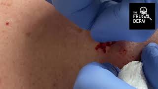 Inflamed cystabscess incision and drainage [upl. by Cinemod478]