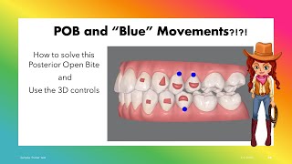 Invisalign ClinCheck  Solve Posterior OpenBite with 3D controls [upl. by Gelb]