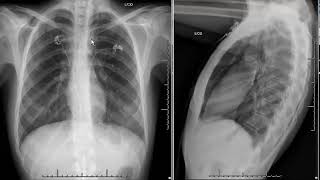 pneumomediastinum [upl. by Xonel]