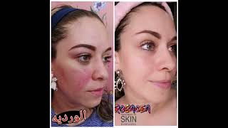 Rosacea الورديه [upl. by Dobb]