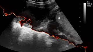 Hemorrhagic Corpus luteum Cyst [upl. by Hoem]