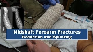 Reduction amp Splinting of Forearm FracturesQuick Version [upl. by Anoyek]