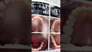 STUDY OF THE MONTH  March 2024 sds youtubeshorts dentalimplants [upl. by Southworth]