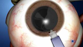 3D Medical Animation CATARACT Surgery by Dr Roberto Aguilar  Animation by Seacoastvideocom [upl. by Chew]