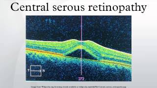 Central serous retinopathy [upl. by Nohsram143]