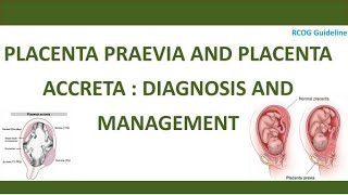 Diagnosis and Management of Placenta Praevia and Placenta Accreta RCOG Guideline [upl. by Elokcin]