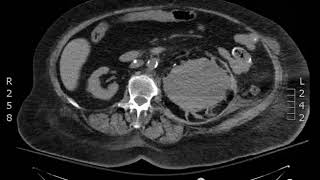 Subcapsular Hematoma CT Axial JETem 2018 [upl. by Reteid944]