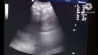 Retroperitoneal cyst on Ultrasound [upl. by Rawna]