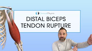 Distal Biceps Tendon Rupture  Expert Physio Review [upl. by Lamrej]