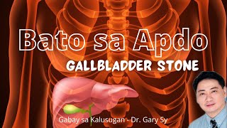 Gallbladder Stone  Dr Gary Sy [upl. by Hyacinth]