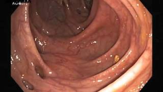 Diverticulosis lesion from Colonoscopy [upl. by Asena667]