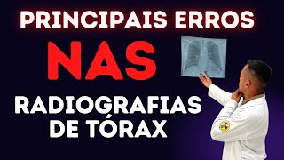 Principais erros nas radiografias de Tórax radiologia [upl. by Euphemia]