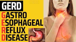 GASTROESOPHAGEAL REFLUX DISEASE  GERD  HEARTBURN  ACID REFLUX  ESOPHAGEAL REFLUX DISEASE [upl. by Rheingold]