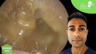 1173  Bursting Eardrum after Discharge amp Ear Wax Removal [upl. by Manon]