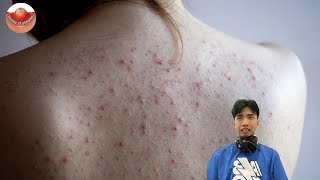 The MOST TERRIFYING Acne Squeezing Videos Youve Ever Seen 3 [upl. by Archy98]