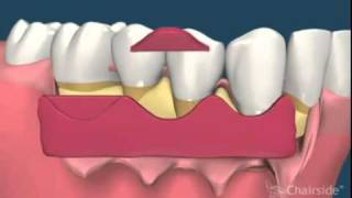 8 Retraccion de encias gingivales Tratamiento [upl. by Estell]