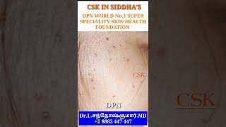 CSK Dermatosis papulosa nigra tamil  DPN tamil  CSK DPN centre [upl. by Jasisa]