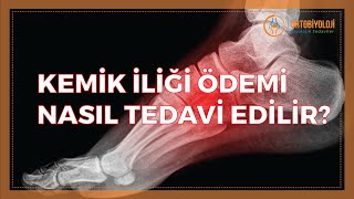 KEMİK İLİĞİ ÖDEMİ NASIL TEDAVİ EDİLİR [upl. by Odnumyer]