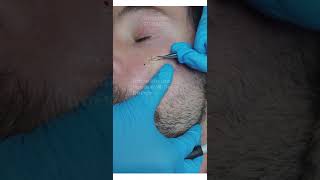 Removal Sebaceous hyperplasia from face using LamProbe [upl. by Heid561]