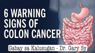 6 Warning Signs of Colon Cancer  Dr Gary Sy [upl. by Assiram]