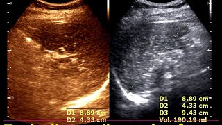 Granulomatous lesions of the spleen  Practical Ultrasonogram Spleen  Lymphoma Spleen [upl. by Daley264]