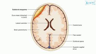 subdural empyema [upl. by Dugaid6]