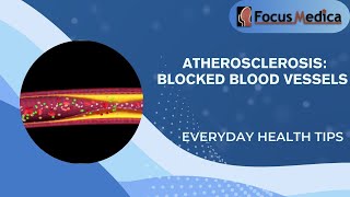 Atherosclerosis Blocked Blood Vessels [upl. by Psyche699]