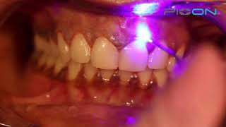 why more doctors prefer to use a dental laser in gingival depigmentation [upl. by Cannice]