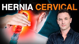 ¿Dolor de Cuello o Cabeza Posible Hernia Cervical  Soluciones Efectivas ✅ [upl. by Yaral]