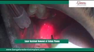 Lichen Planus Removal In Bangalore  Mouth Infection Treatment In India [upl. by Lleihsad798]