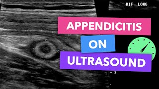 Appendicitis on ultrasound  Radiopaedias Emergency Radiology Course [upl. by Aros]