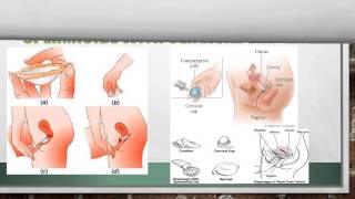 Contraception Informational Commercial Spermicide HSC 425 Sec15 [upl. by Jordain]