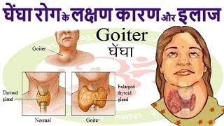 घेंघा  Goiter  रोग Enlarged Thyroid Gland के लक्षण कारण और इलाज [upl. by Thagard]