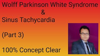 Wolff Parkinson white Syndrome Sinus Tachycardia [upl. by Ferwerda]