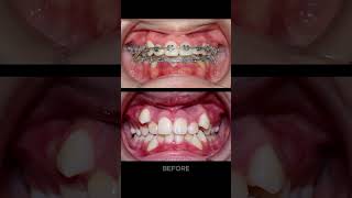 25 years braces process [upl. by Ytsirc362]