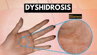 Dyshidrosis Causes Signs and Symptoms Diagnosis and Treatment [upl. by Nogaem972]